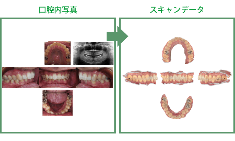 術前口腔内のデータ化