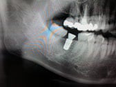右側下顎第二大臼歯の欠損症例 