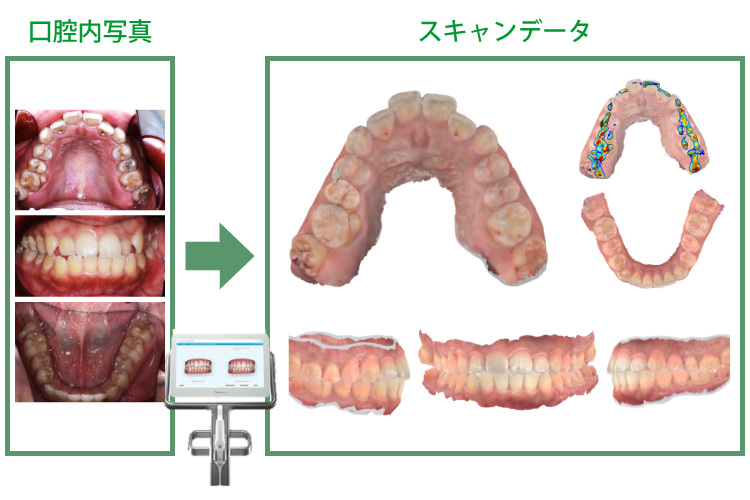 術前口腔内のデータ化