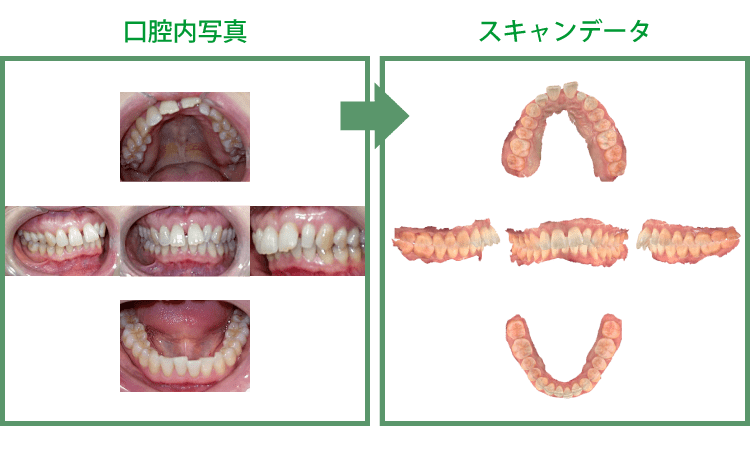 術前口腔内のデータ化