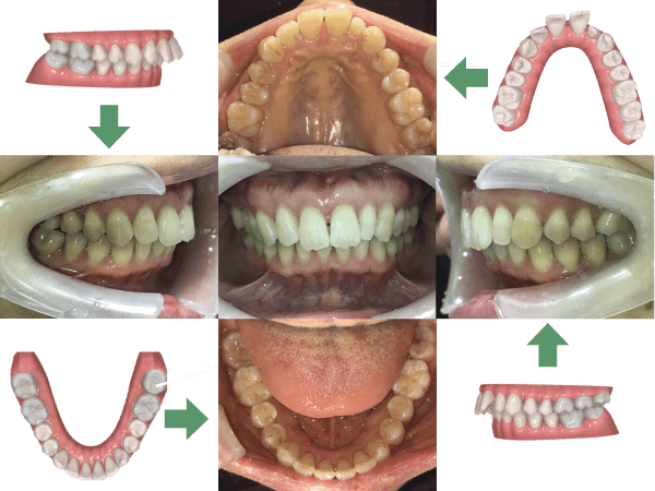 矯正終了後口腔内写真