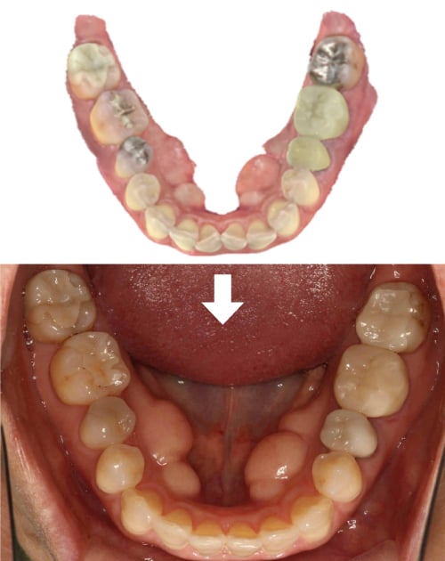 正中離開（真ん中の歯と歯の間に隙間がある）下叢生（下の前歯〜小臼歯の凸凹）矯正+補綴