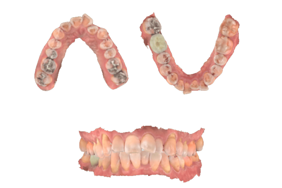 iteroでスキャンした口腔内の情報:画像