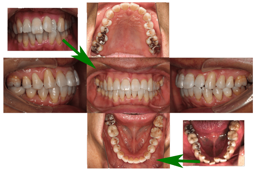 矯正終了時口腔内写真:画像