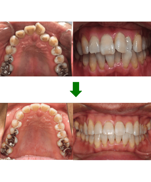 矯正+ホワイトニング症例:画像