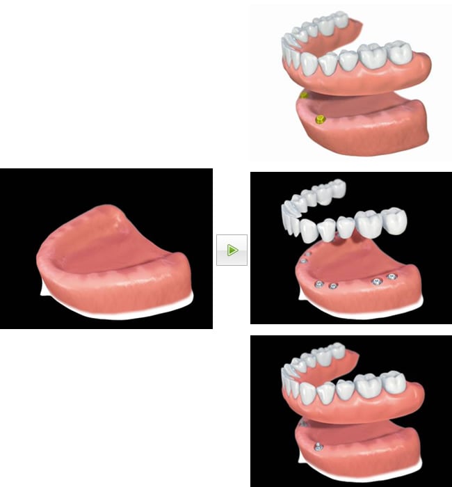 インプラントを併用した半固定式の入れ歯治療