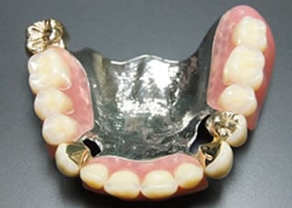金属を使用した入れ歯の特徴