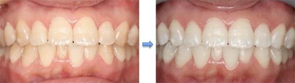 1～2週間続ける事で歯の色が白く変化してきます。