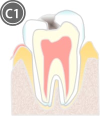 C1：初期むし歯