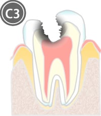 C3：象牙質のむし歯